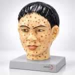 Small Pox Face Model